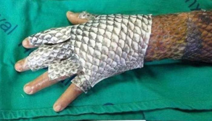 اكتشاف علاج جديد للحروق باستخدام جلد السمك