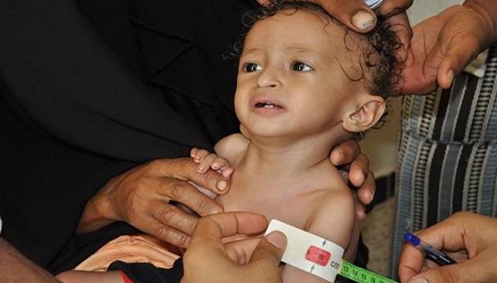 “الشيتاني”: 20% من أطفال مصر يعانون من التقزم بسبب سوء التغذية