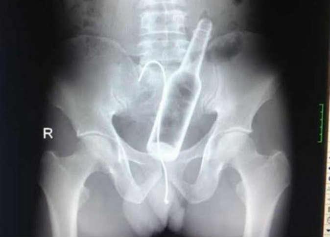 العثور على زجاجة داخل بطن مريض صيني