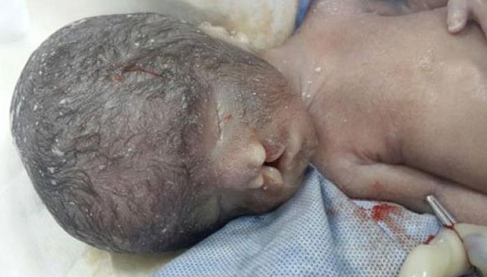 بالصور.. ولادة طفل دون عيون في أحد مستشفيات القاهرة