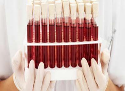 تحليل دم بسيط يتنبأ بفرص الإصابة بالمرض الذهنى