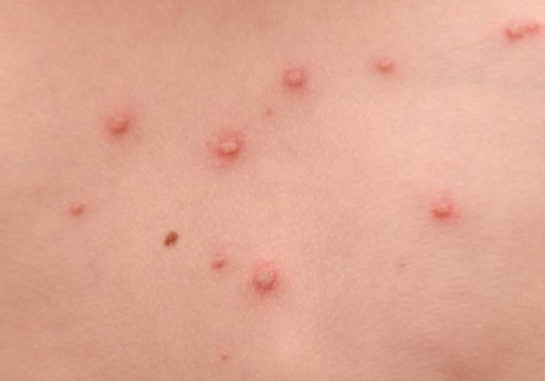 ظهور 21 حالة اشتباه بمرض الجدري بالمنوفية