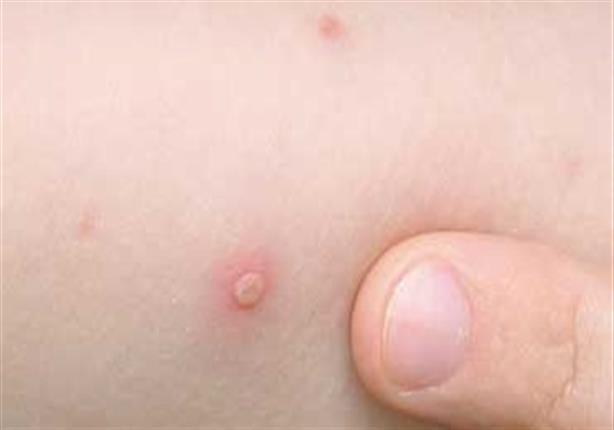 إصابة 23 تلميذا بمرض الجدري بمدرسة في بني سويف