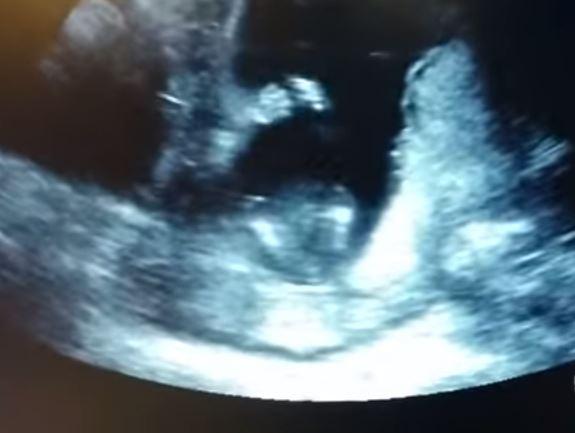 بالفيديو.. جنين يصفّق داخل رحم أمه