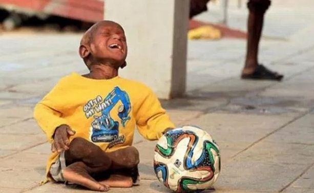 بالصور والفيديو.. حالة مرضية نادرة تحول طفلًا إلى تمثال حجري