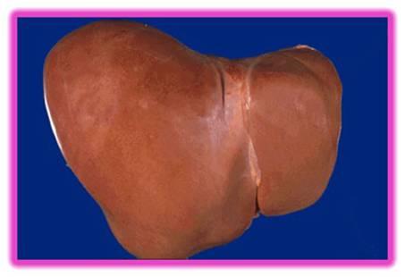 مرضى التليف يمتنعون.. روشتة الصيام الآمن لمريض الكبد