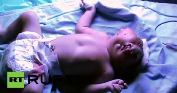 فيديو | ولادة طفل بوجهين في الهند