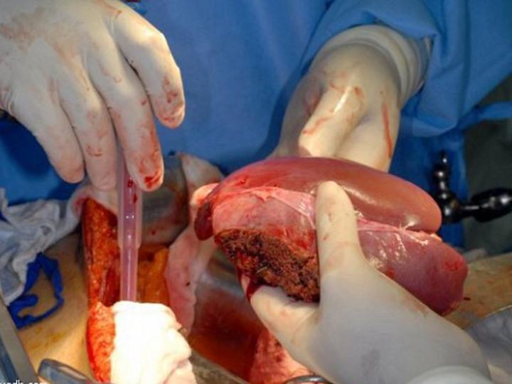 الكلية بـ40 ألف.. تقرير بريطاني يكشف شبكة لتجارة الأعضاء البشرية بمصر