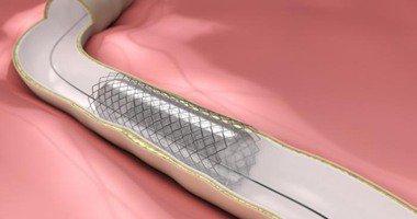 ابتكار دعامة قلب من مواد قابلة للتحلل أفضل من العادية