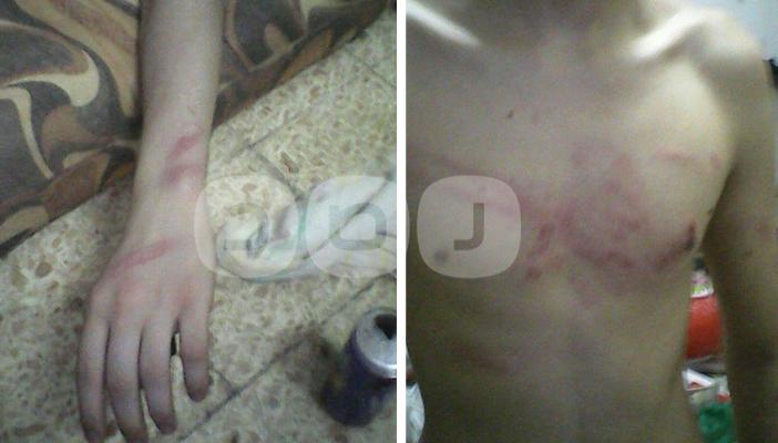 بالصور.. آثار التعذيب على  معتقلي سجن المستقبل بالإسماعيلية