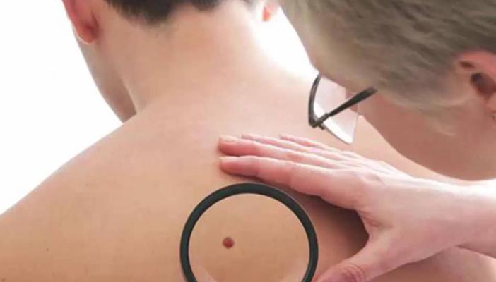 دراسة.. “الشامة” من علامات الجمال لكن وجودها له دلائل خطيرة