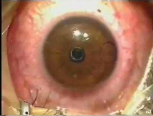 بالفيديو.. عملية تصحيح النظر “ليزك العيون”