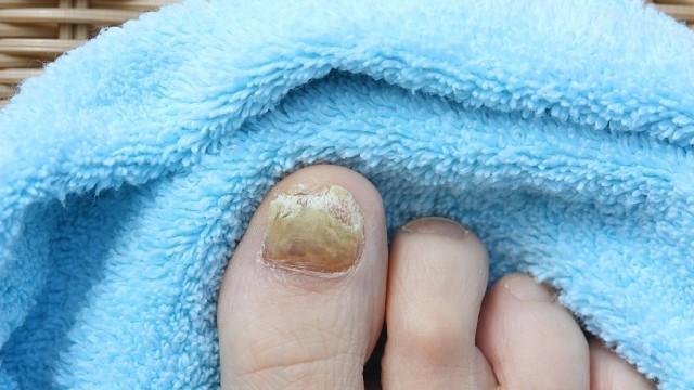 مستشعر ذكي لأقدام مرضى السكر