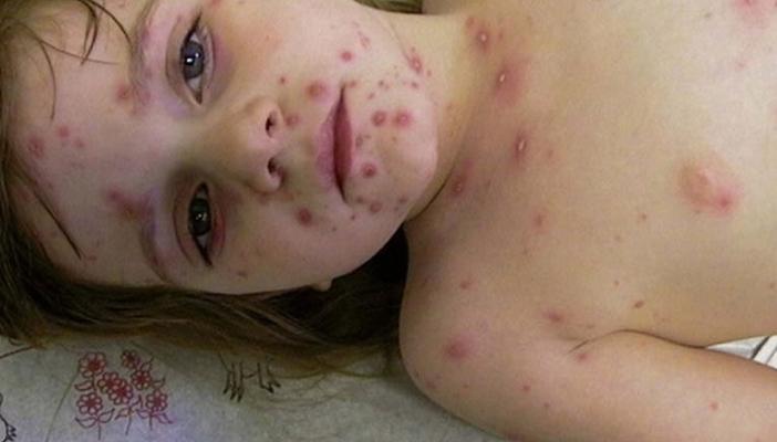 إصابة 17 تلميذا بالجدري في مدرسة ابتدائية بكفر الشيخ