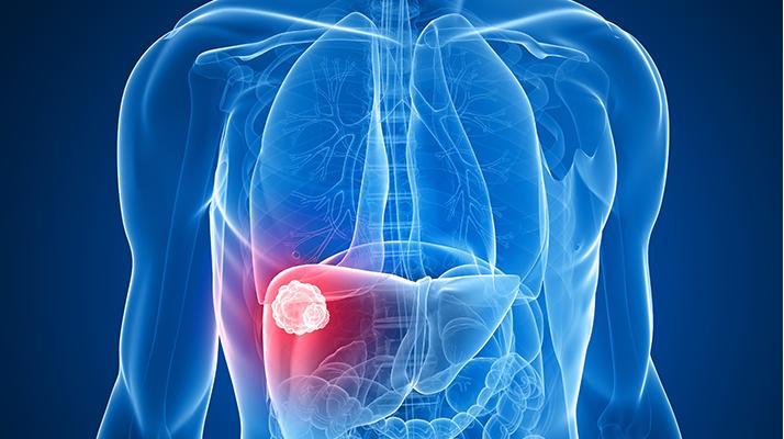 جامعة “ليذر”: اكتشاف فيروسات تساعد في علاج سرطان الكبد