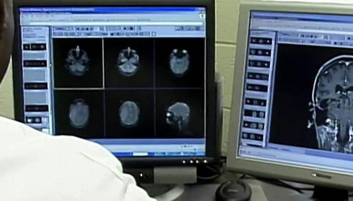 لقاح يعزز فرص النجاة لمرضى سرطان المخ