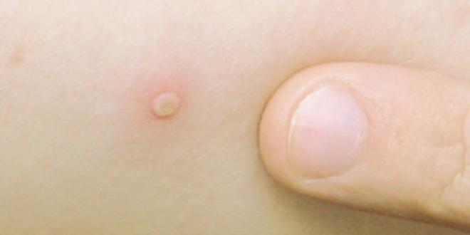 صحة دمياط: 13 حالة إصابة جديدة بالجديري المائي بين طلاب المدارس