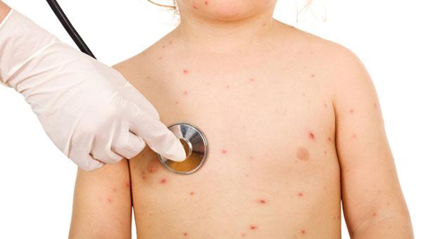 ارتفاع الاصابات بالجديري المائي بين تلاميذ دمياط لـ”72″